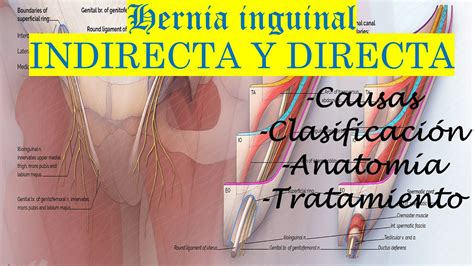 hernia inguinal directa anatomia