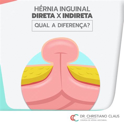 hernia inguinal direta causa