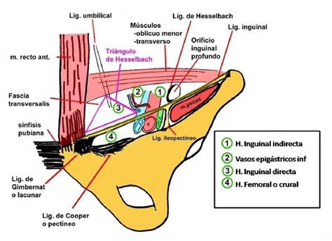 hernia inguinal direta vasos epigastricos