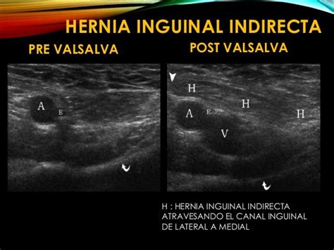 hernia inguinal indirecta ultrasonido