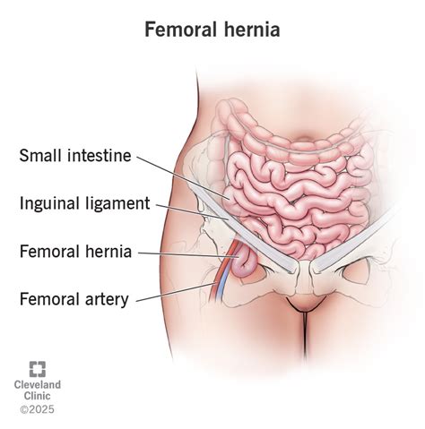Understanding Hernia of Female: Causes, Symptoms, and Treatments