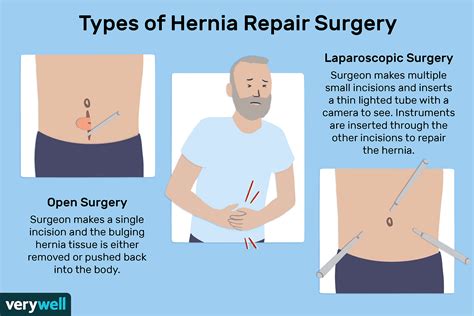 hernia operation procedure