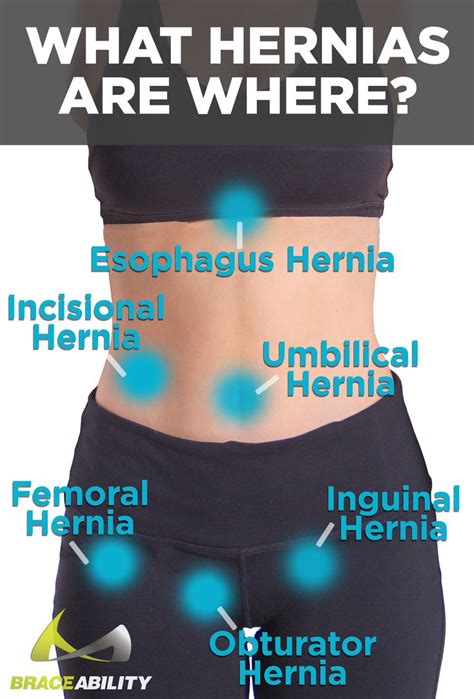hernia symptoms in women stomach
