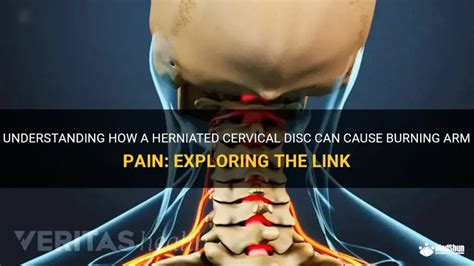 Herniated Disc Burning Pain