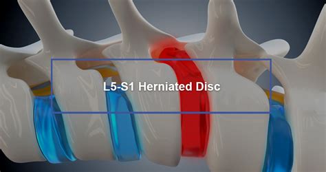 Herniated Disc In Back L5-S1