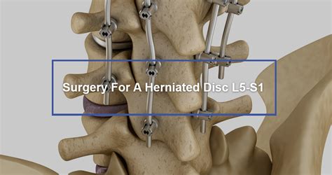 Understanding the Herniated Disc Operation: Is Surgery Your Best Option?