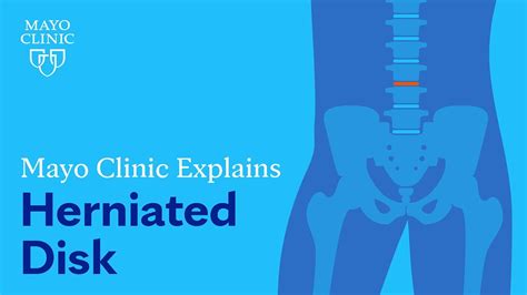 herniated disc symptoms mayo clinic