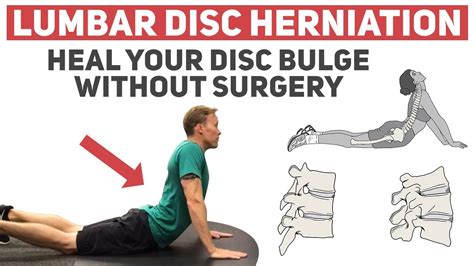herniated disc treatment lower back
