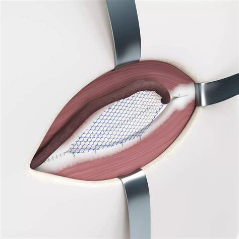 Leistenbruch, minimalinvasive Operation, inguinal hernia, minimal invasive surgery DocCheck
