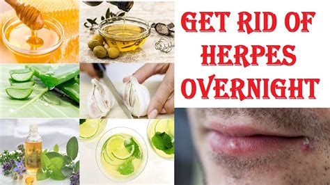 herpes cure and treatment