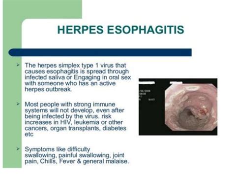 herpes esophagitis treatment