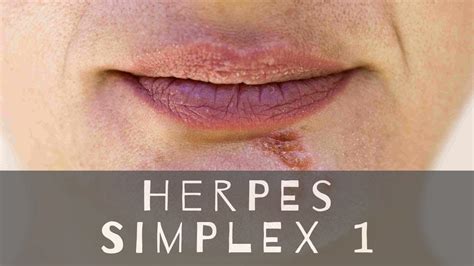 herpes hsv 1 genital