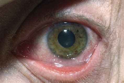 herpes simplex 1 in eye