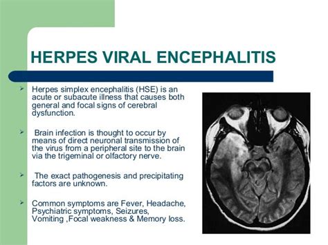 herpes simplex encephalitis symptoms
