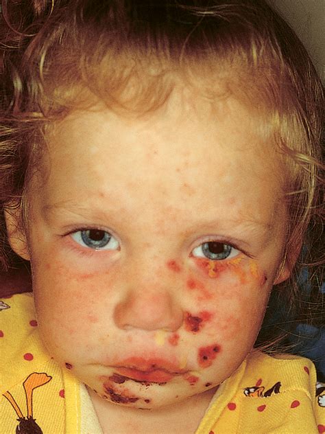 herpes simplex in children