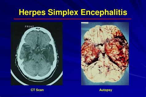 herpes simplex viral encephalitis
