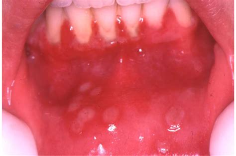 herpes simplex virus hsv mouth infection