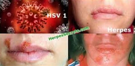 herpes simplex vs herpes
