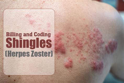 herpes zoster icd 10