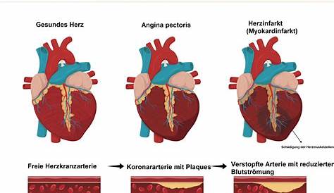 Weniger Herzinfarkt, Schlaganfall und Herztod :: Infovita