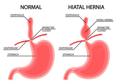 hiatal hernia in esophagus