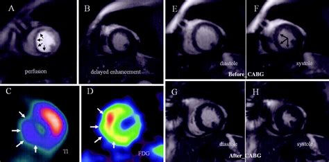 hibernating myocardium radiology