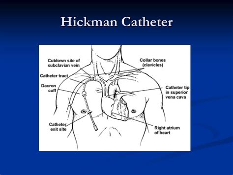 Hickman Catheter Placement Cpt Code