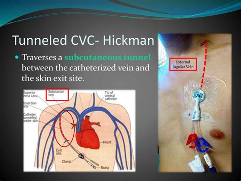 Hickman Catheter Position