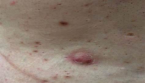 Is Your Acne Really Hidradenitis Suppurativa