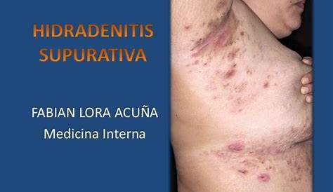 Hidradenitis Suppurativa Breast Surgery Archives Of Plastic