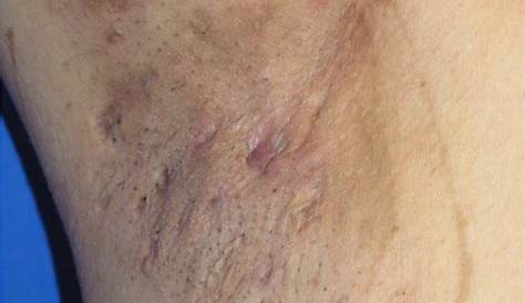 Hidradenitis Suppurativa Early Stages