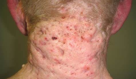 Hidradenitis Suppurativa Face Treatment The Of By Cellulose
