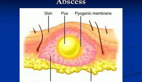 Hidradenitis Suppurativa Groin Area (Hurley's Staging II) In The Left