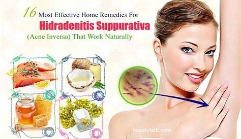 Make Use of Given 10 Natural Remedies for Hidradenitis
