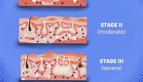 Hidradenitis Suppurativa Stage 1 HS Stages HidraWear