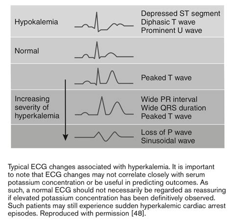 ECG changes Potassium. How to memorize things, Heart rhythms