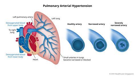 high blood pressure in the lung arteries