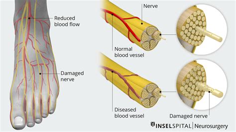 High Frequency Nerve Damage
