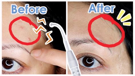 High Frequency Zapping