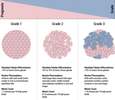 high grade dcis breast cancer