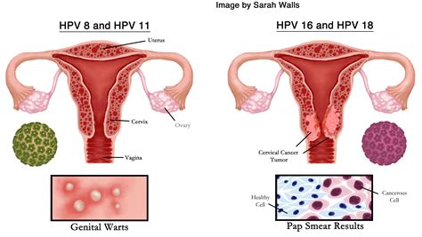 high hpv