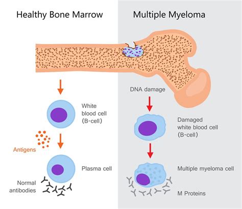 high iga levels multiple myeloma