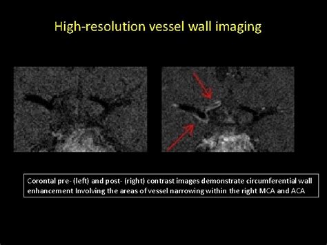 High Resolution Vessel Wall Imaging