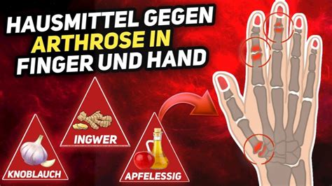 hilfe bei arthrose in den fingern