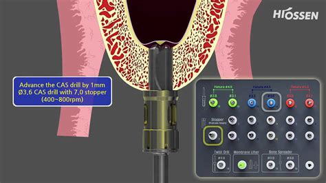 hiossen sinus lift kit