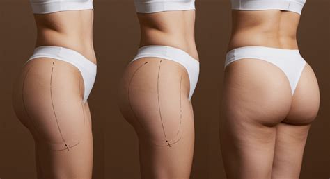 hip and butt augmentation