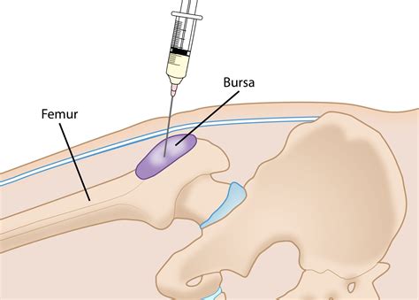 Effective Hip Pain Relief: Hip Bursa Injection Explained