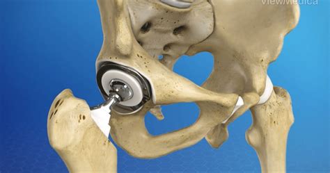 Regain Mobility: What to Expect from Hip Replacement Surgery