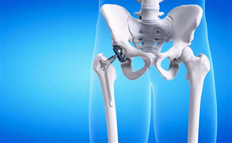 Hip Replacement Surgery Kaiser