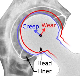 Hip Replacement Wiki